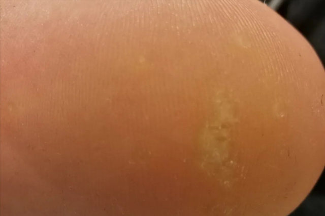 角化棘皮瘤的病理要点