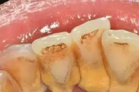 不得不承认！这两招去除牙结石超管用，学会终身受益！！图片