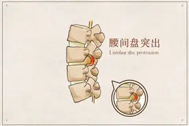 腰椎间盘突出有哪些症状？如何预防？图片
