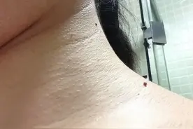 脖子和腋下总长“小肉粒”？可以用手揪吗？医生：与7种疾病有关图片