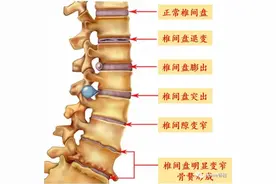 （收藏）详解腰椎间盘突出症图片