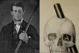 23张罕见图片，被铁棒插穿头骨后，竟奇迹般的存活了下来图片