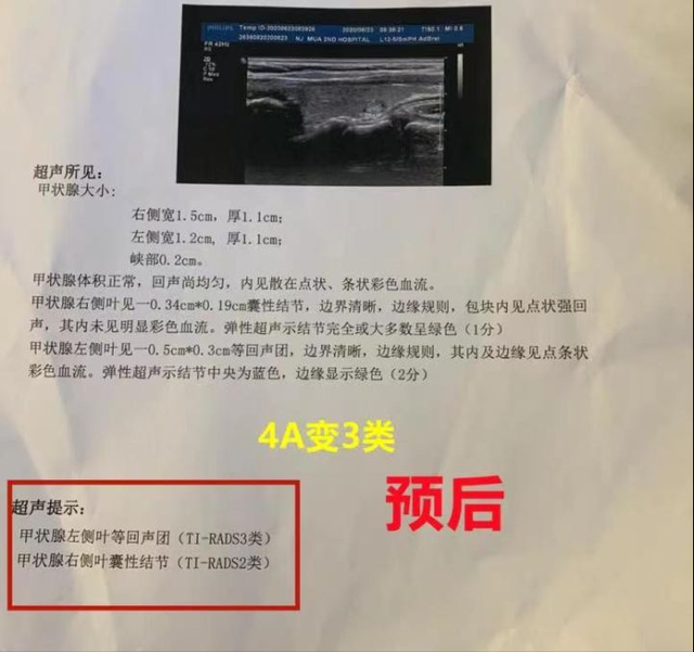 甲状腺结节4a已经20年了 甲状腺结节4a已经20年了正常吗