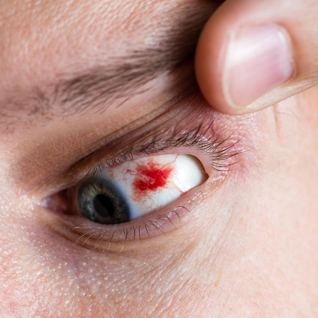 如果你的眼睛布满血丝,可能是这种严重情况的征兆,不要忽视