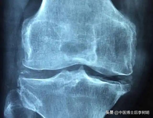 得了骨关节炎，千万不要自己养