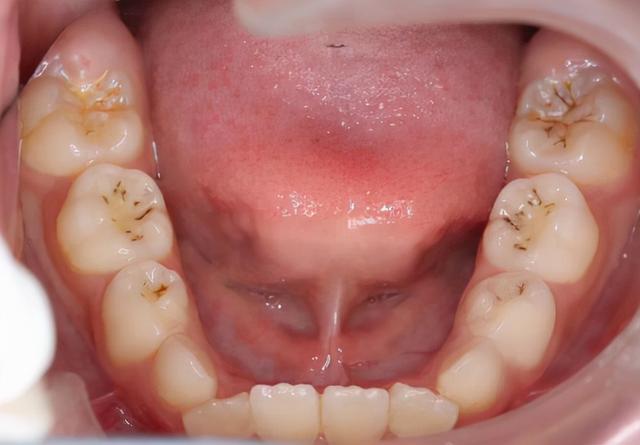 吸烟等都可能给你漂亮的牙齿留下几个"污点", 而我们的牙齿虽然表面上