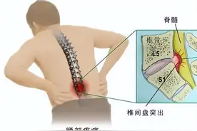 同样是患了腰椎间盘突出症，怎么疼痛的位置会不一样呢？图片