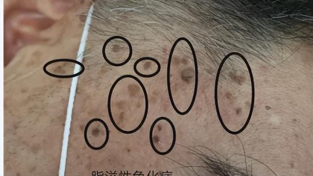 老年性角化病严重吗