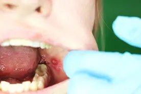 27岁女子口腔溃疡，半年后却被割掉半边舌头，病因令医生脸红心跳图片