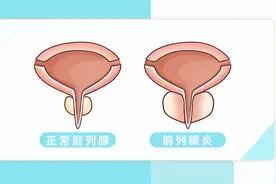 前列腺炎是细菌感染引起的吗？要怎么治疗？图片