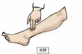 中医产后消水肿，和大象腿说拜拜图片