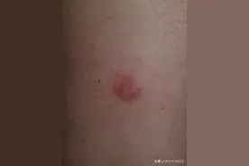 手上起小水泡，又红又肿特别痒，王忠山教授提醒您祛湿很重要图片