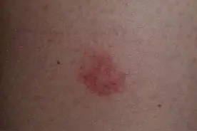 手上起小水泡，又红又肿特别痒，王忠山教授提醒您祛湿很重要图片