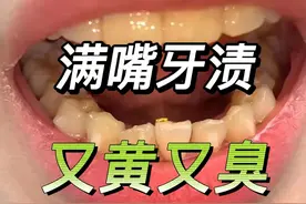 大黄牙又脏又臭怎么办？快试试这个法子，轻松美白牙齿去牙渍！图片