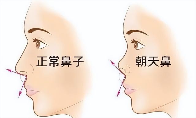 鼻子塌不算什么,"鼻孔外露"才拉垮,显老又显凶,太多人遭殃