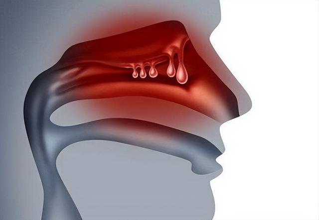 息肉,我们并不生疏鼻塞的患者到门诊看病见了醫生的第一句话便是鼻子
