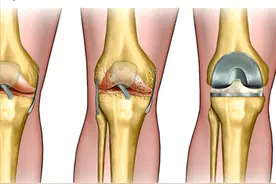 从手术前到手术后，简单了解膝关节置换手术图片