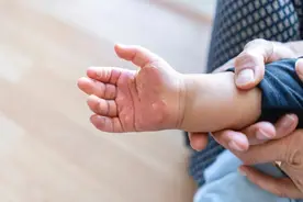 儿童被烧伤或烫伤该怎么办？图片