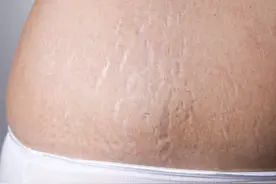 有没有搞错｜男生怎么会有妊娠纹图片
