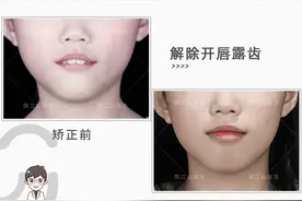 隐适美案例丨9岁女孩嘴包不住牙，是什么原因？要不要拔牙矫正？图片