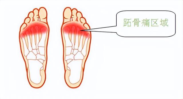 走路时前脚掌痛？警惕“跖痛症”