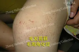 如何拯救烦人的“鸡皮肤”图片