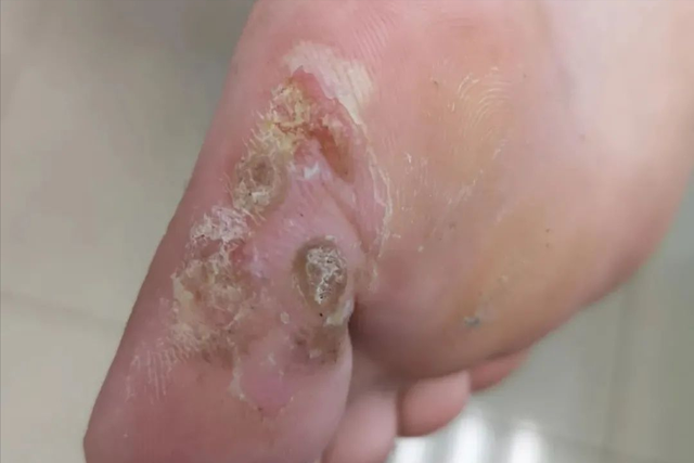 角化棘皮瘤的病理要点