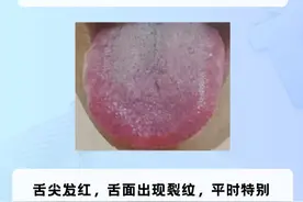 舌头有裂纹，大病来找，小病难缠，一个中成药，告别裂纹舌！图片