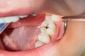 牙痛还脸肿，我后悔没有早点处理我的蛀牙！图片