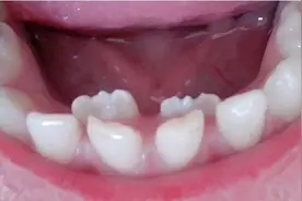 双排牙一定得拔？几岁换牙才正常？6大换牙难题，专家说大实话图片