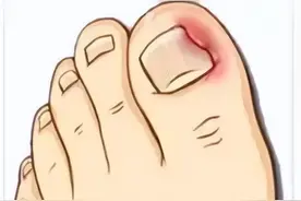 脚趾甲老往肉里钻，一碰还疼？教你小妙招，预防甲沟炎告别疼痛图片