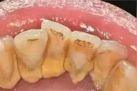 曝光过来人顶好的去牙结石方法！每天3步，牙结石全部消失不见！图片