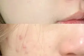 这个去痘印的方法你一定要知道！亲测有效！图片