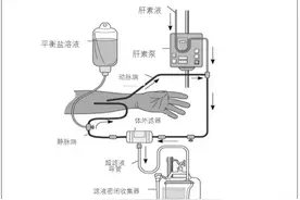 基于ICU的肾脏替代治疗图片