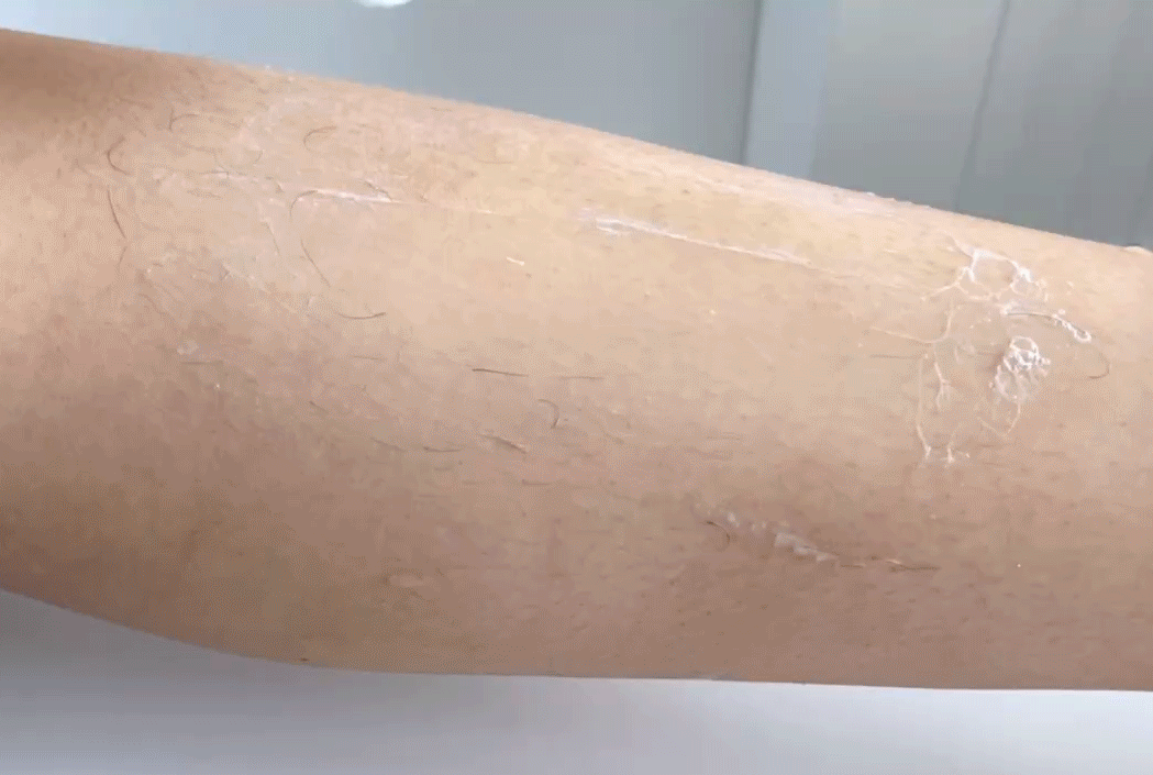 冰点脱毛以后可以擦身体乳吗