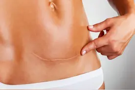 同样是剖腹产，为什么你的疤痕比别人丑？和产后常做的几件事有关图片