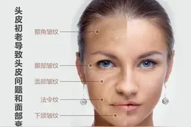 头皮每松弛2.54cm，视觉年龄就会增加5.7岁是真的吗？图片