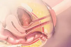 女性尿道口的结构是怎样的？图片