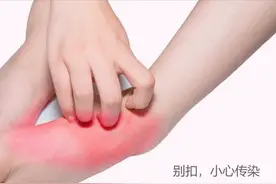 脚痒，奇痒无比！脚气足癣每到夏季更严重，用药方案看这里图片