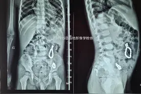网红玩具 暗藏危险——29粒磁力珠，3岁男童胃肠8处穿孔！图片