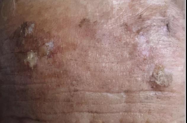 日光性角化发展