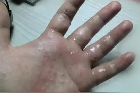 带你了解汗疱疹那些事图片