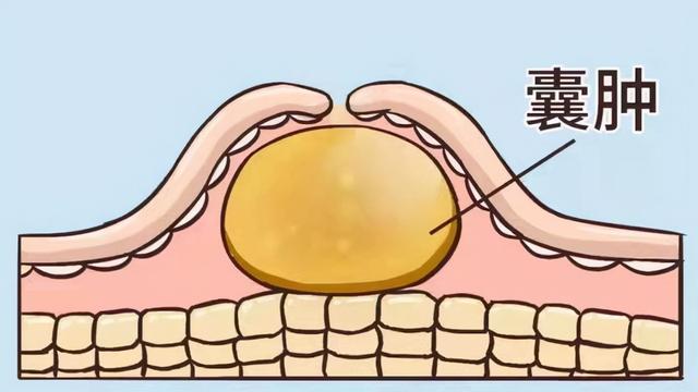 宫颈纳氏囊肿是什么意严重吗（什么是纳氏囊肿宫颈纳氏囊肿会变癌吗让医生告诉你）