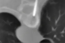 腰突症压迫硬膜囊，看看这个方子！图片