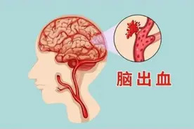 脑出血发病突然，好好的人说没就没了，脑出血的4个征兆了解一下图片