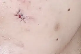 女子用粉刺针挑痘痘致脸部感染手术缝6针：表皮样囊肿，拖了1年，缝了2层图片