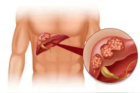 提醒：肝癌来临时，头部可能会出现4个“迹象”，建议尽早做筛查图片