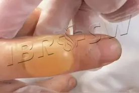 又见水疱！刺破还是保留？图片