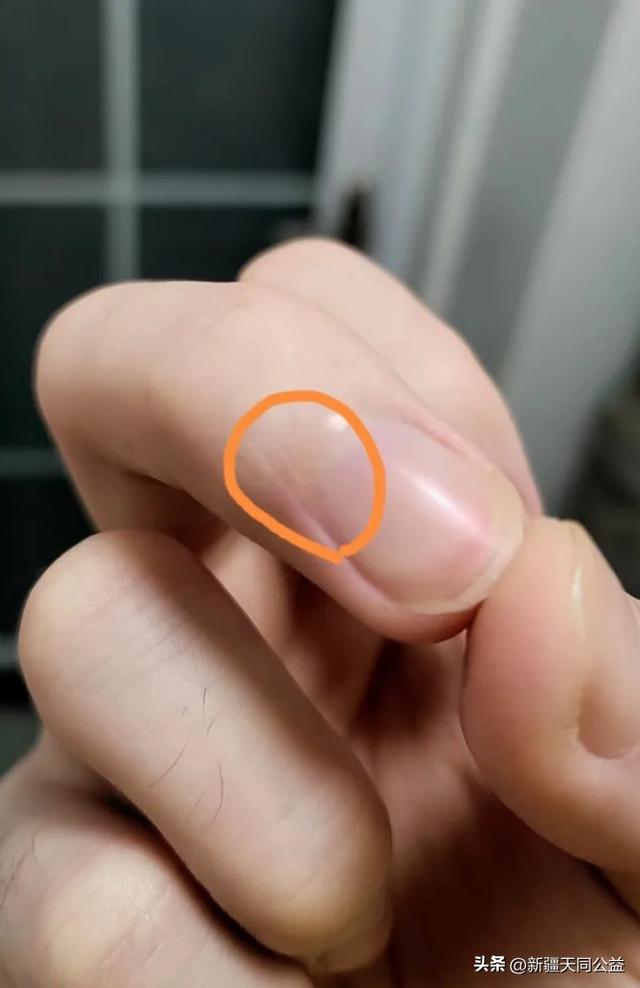 你都是怎么发现自己感染艾滋病的？