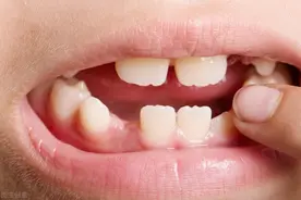 宝宝牙齿之间有空隙，是牙齿没发育好，还是正常现象？图片